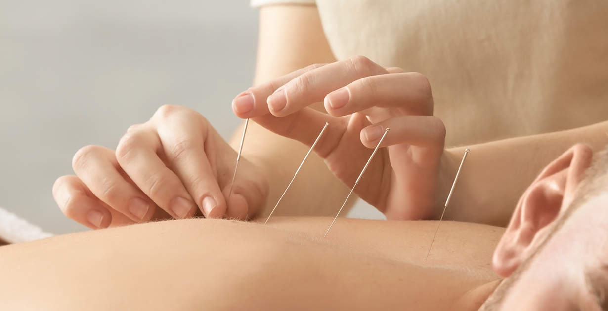 Acupuncture + Electro-Acupuncture